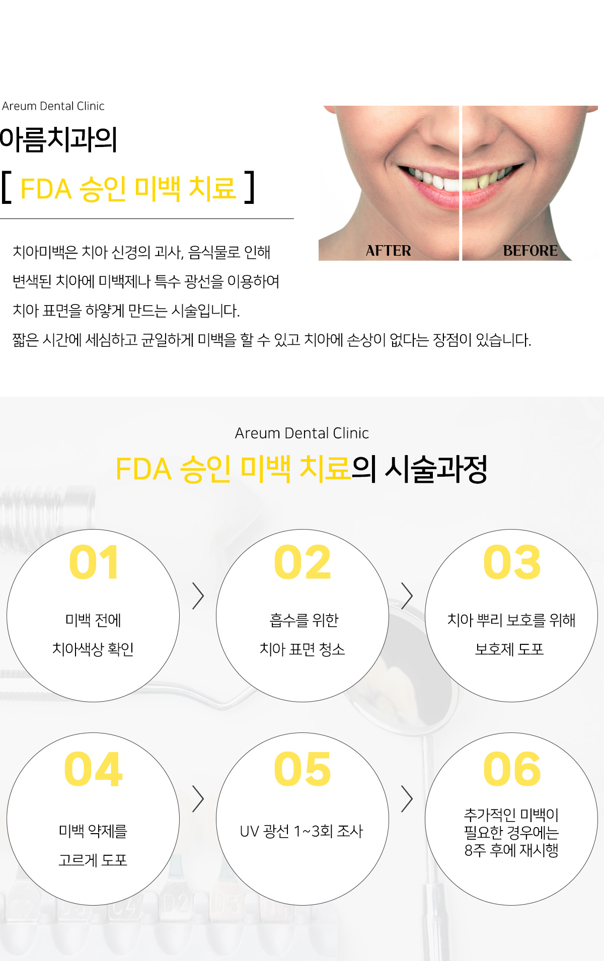 FDA 승인 미백 치료